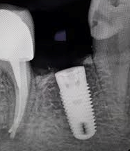 Radio de dents dont un implant dentaire.