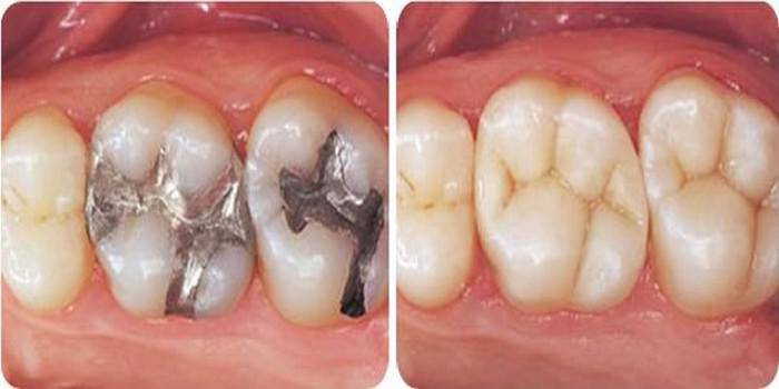 Le danger des amalgames dentaires au mercure