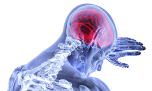 Image en transparence d'un cerveau après un accident vasculaire cérébral.