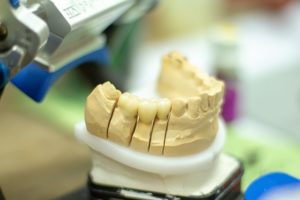 Un moulage de dents pour fabriquer une prothèse dentaire.